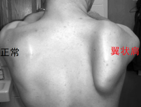 正常肩胛和翼狀肩對比圖