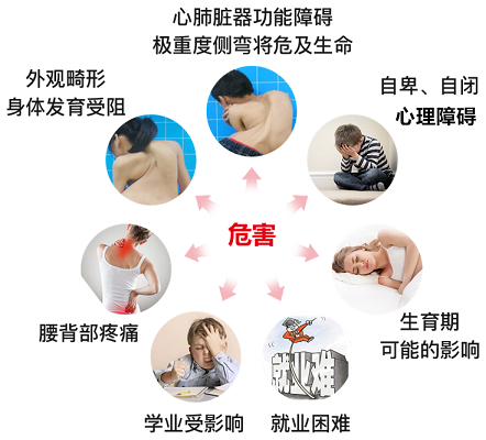 脊柱側彎危害