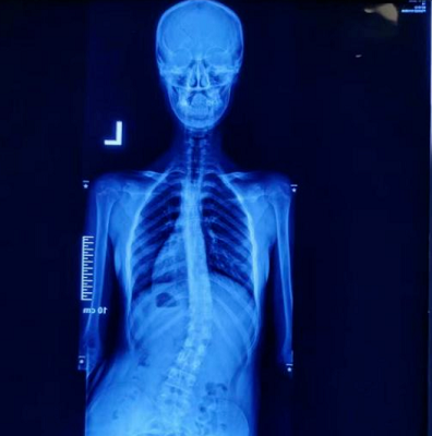 直樂醫院脊柱側彎案例