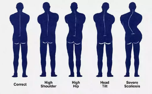 脊柱側(cè)彎發(fā)展過程