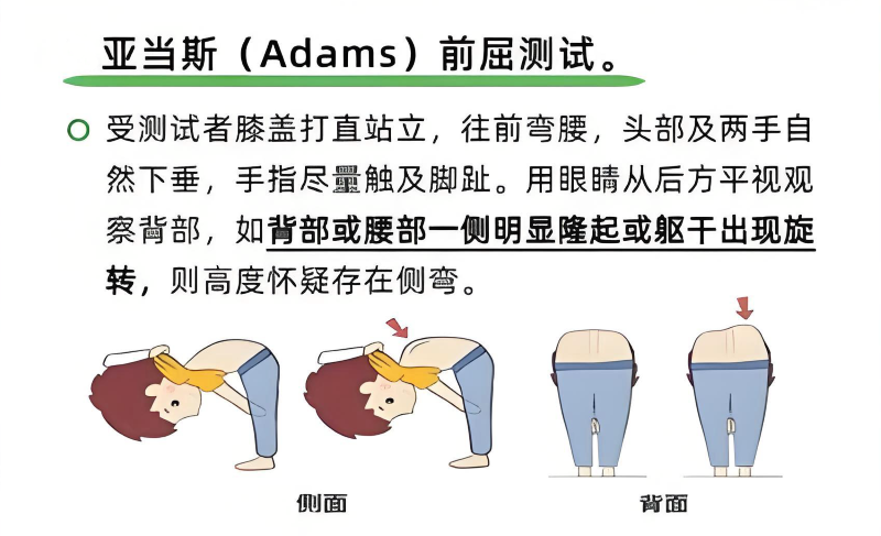 脊柱側彎亞當斯前屈測試