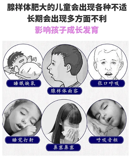 腺樣體肥大危害 腺樣體肥大危害